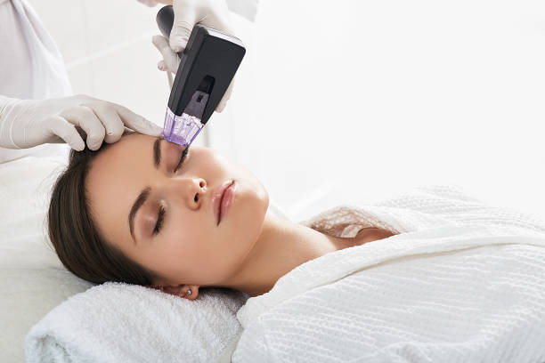 Does Fractional RF Micro Needling Minimize Fine Lines?