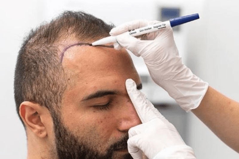 Does Hybrid Hair Transplant Look More Natural?