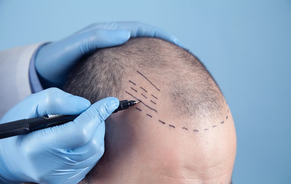 Does Scalp Micropigmentation Need Maintenance?