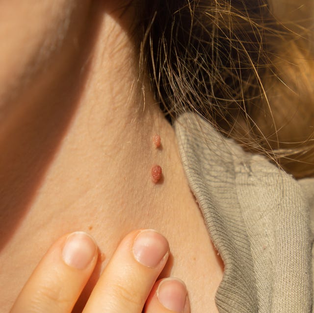 Does Skin Tag Removal in Abu Dhabi Offer Lasting Results?