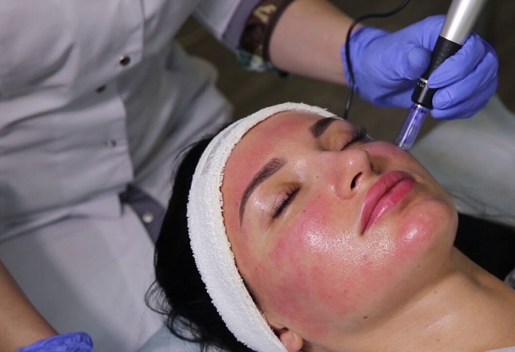 Does Vampire Facial Improve Skin Texture and Tone?