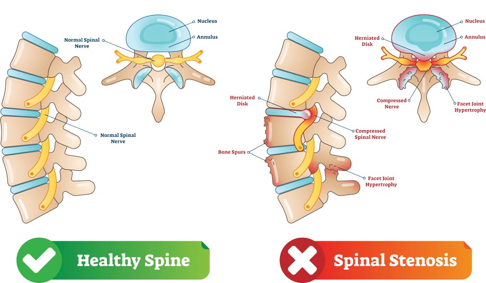 How Can Foraminal Stenosis Treatment In Decatur TX Help Me?