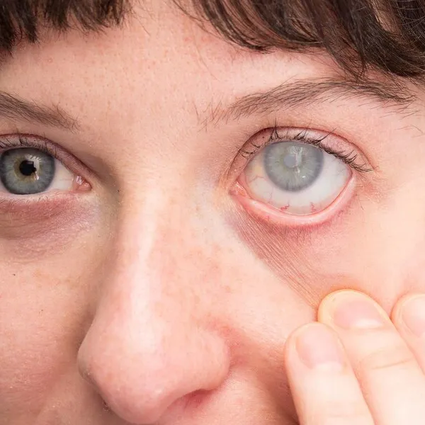 Everything You Need to Know About Glaucoma Treatment Before Vision Loss Starts