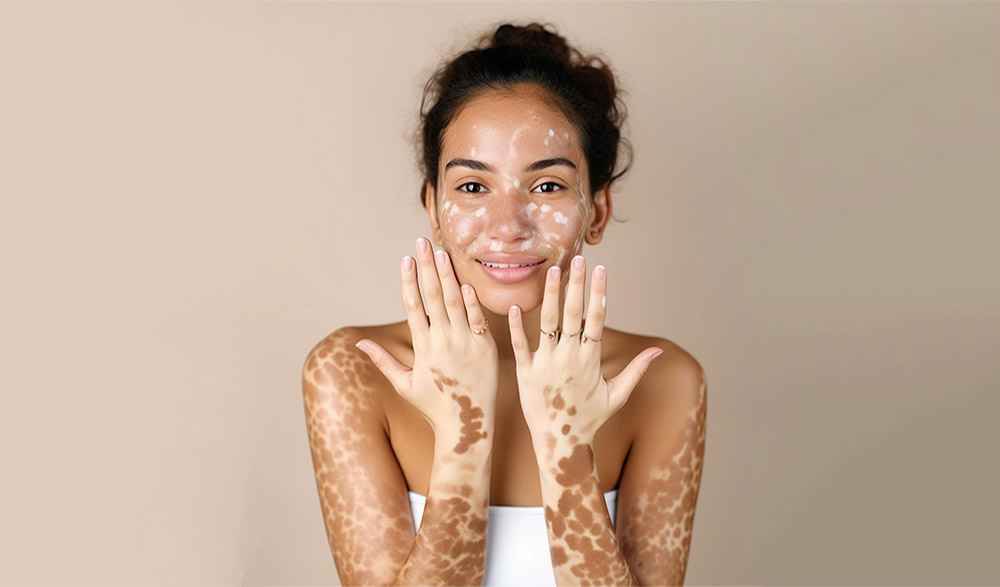 How Can Vitiligo Treatment Improve Skin Appearance?