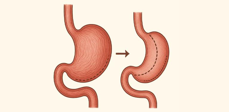 How Does Gastric Bypass Reduce Hunger and Appetite?