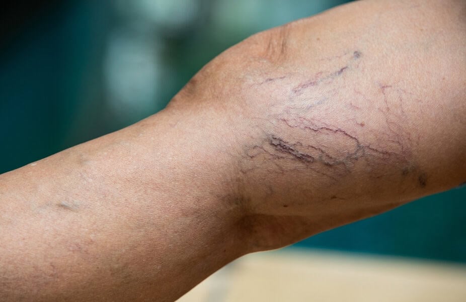 How Does Spider Vein Treatment in Abu Dhabi Reduce Veins?