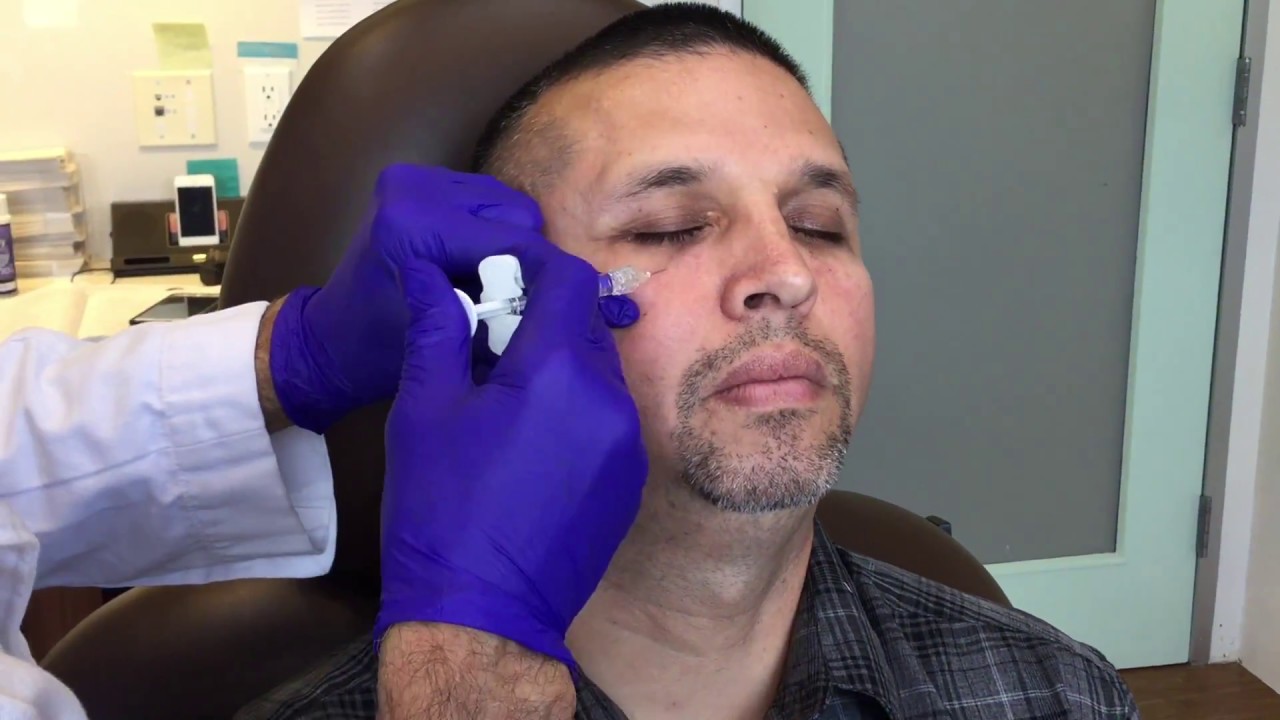 How Long Do Dermal Fillers Last After Treatment?