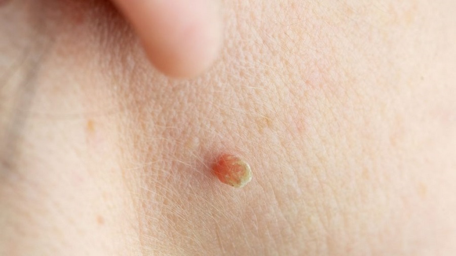 How Safe Is Modern Warts Removal Treatment Abu Dhabi?