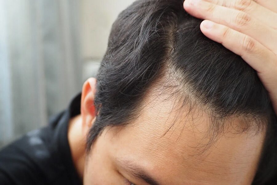 How Soon Does Hair Loss Treatment Show Results?