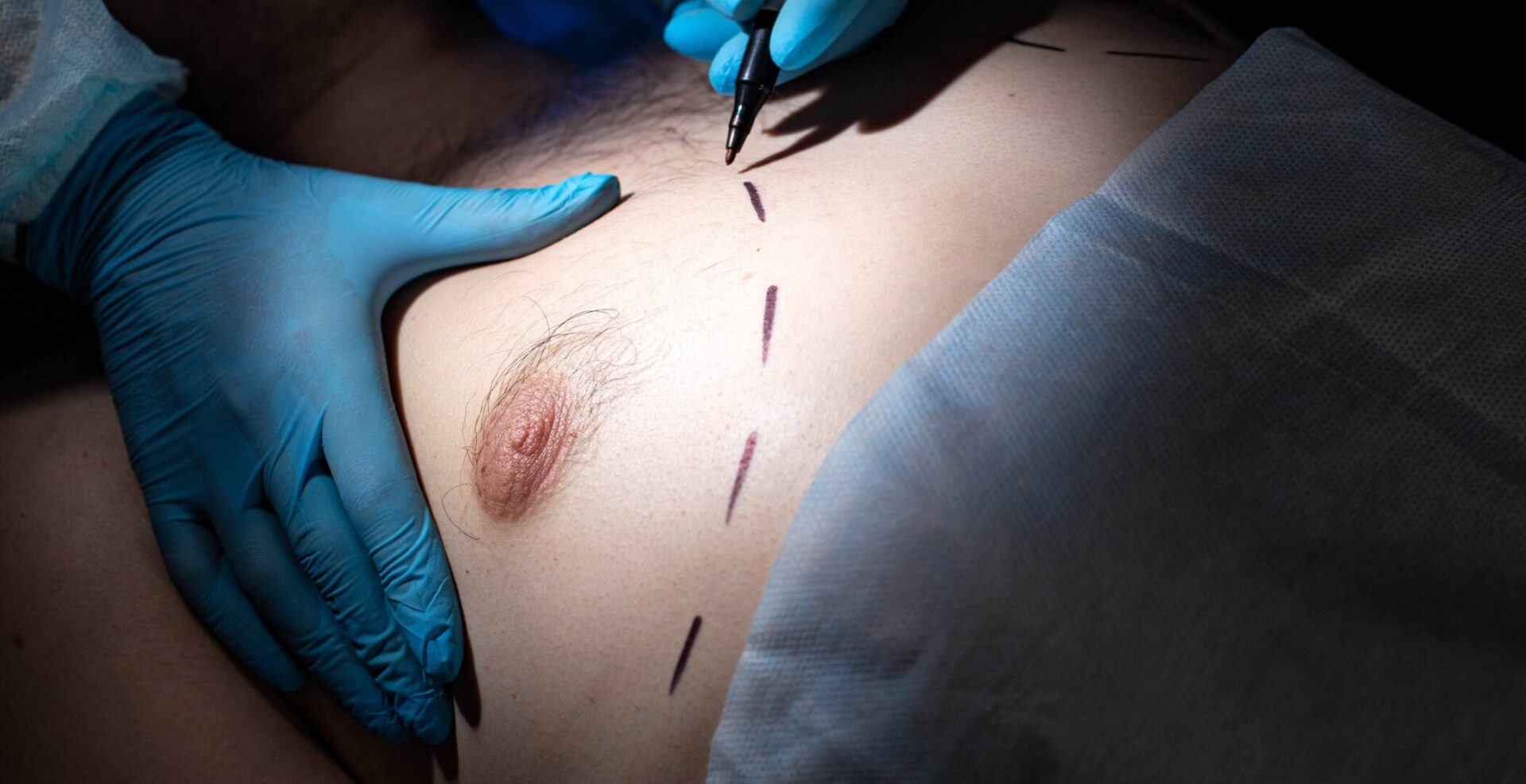 Inverted Nipple Surgery and Scar Minimization Methods