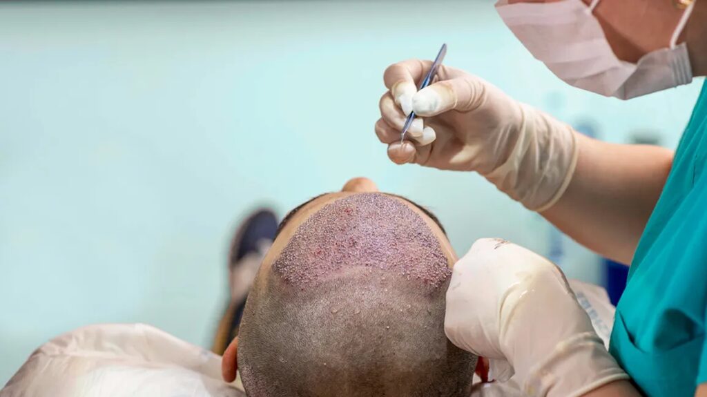 Is FUE Hair Transplant in Abu Dhabi a Permanent Solution?