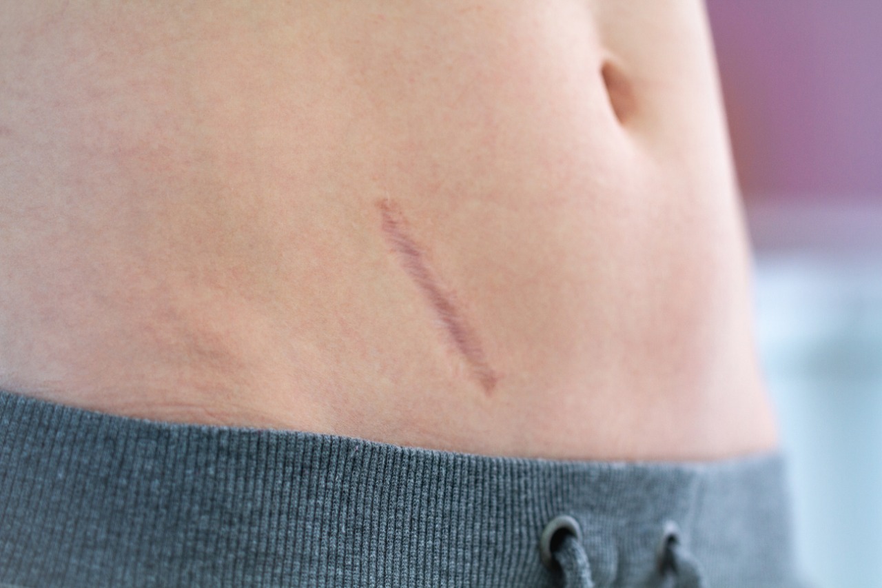Is Keloid Treatment Abu Dhabi Suitable for Everyone