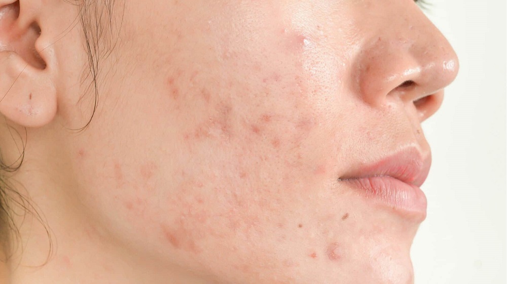 Is Laser Acne Scar Treatment Worth Considering?