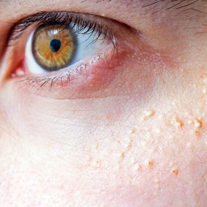 Is Milia Treatment in Abu Dhabi Suitable for Everyone
