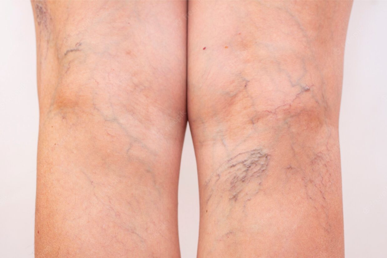 Is Sclerotherapy Abu Dhabi Suitable for All Skin Types?
