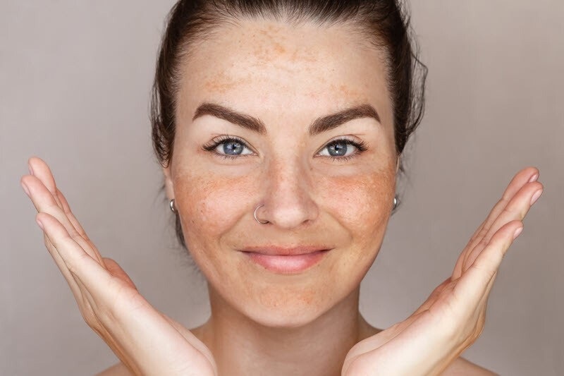 Can Melasma treatmentReduction Improve Appearance?