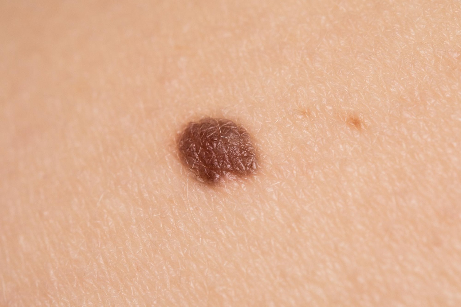 Why Do Moles Appear on the Skin: A Complete Guide