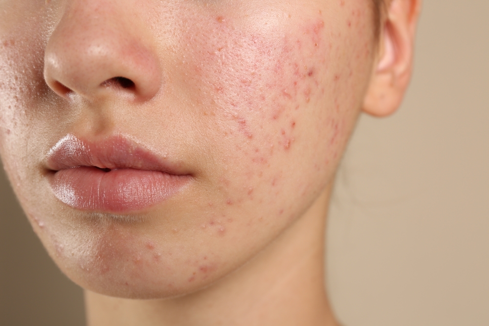 Say Goodbye to Breakouts with Effective Acne Treatment