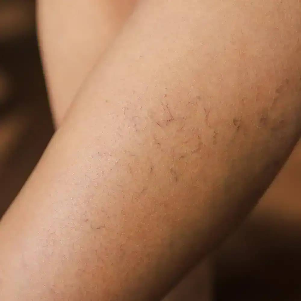 Say Goodbye to Visible Veins with Advanced Spider Veins Treatment