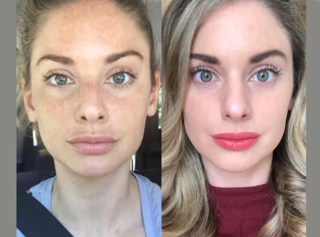 Anti-Aging Solutions by Best Plastic Surgeon in dubai Using RF Microneedling