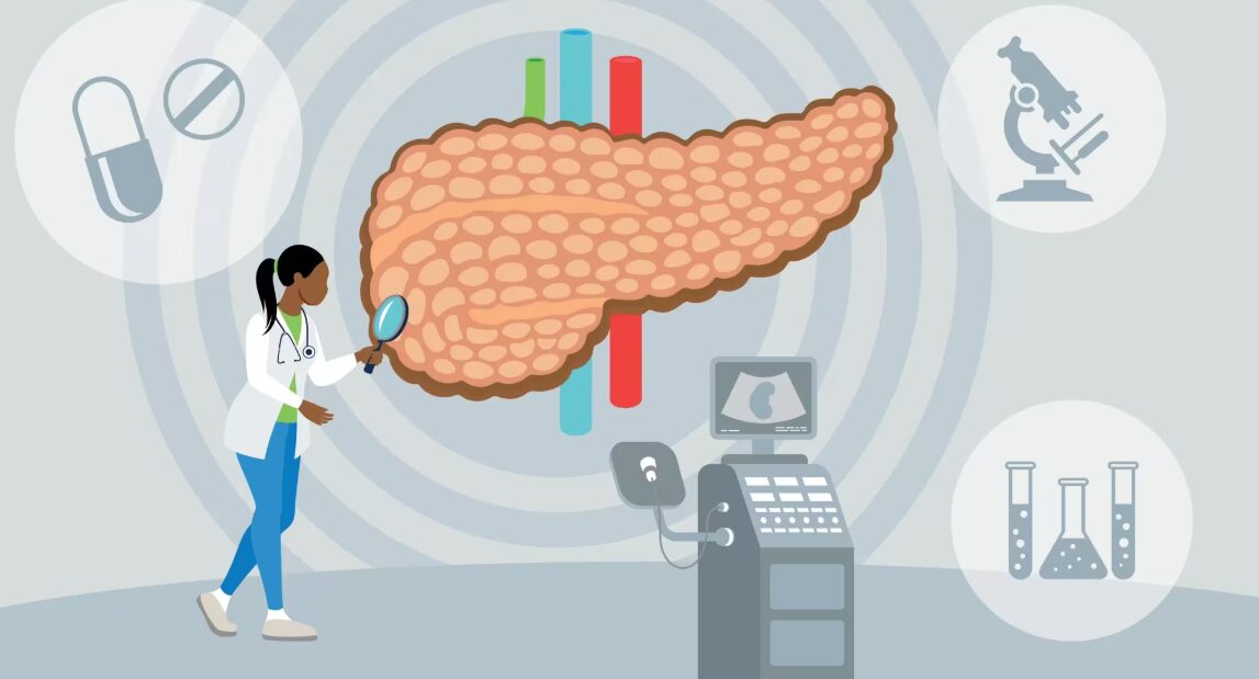 Why Pancreatic Cancer is Often Detected Late and How to Spot It Early
