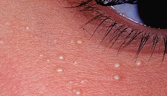 Milia Treatment in Dubai clear radiant skin flow natural beauty rise