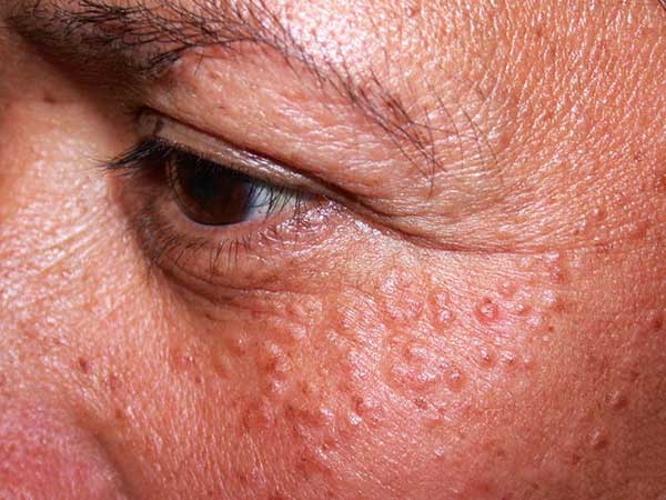 Advanced Glow Energy Syringoma Removal Treatment for Smooth Radiance