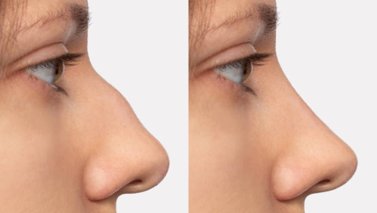 Nose Job in Dubai: Understanding Surgical and Non-Surgical Options