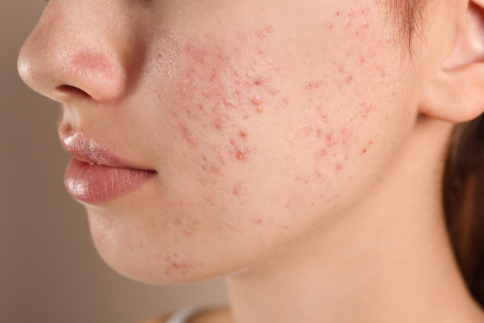 What Are Gentle Treatments for Sensitive Pimples?