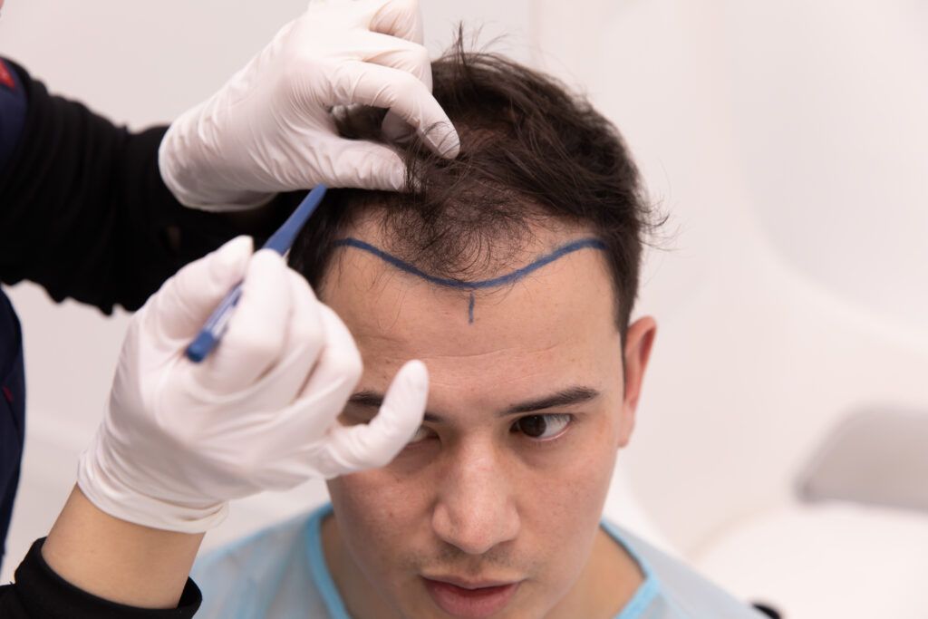 What Are the Benefits of a Scarless Hair Transplant?
