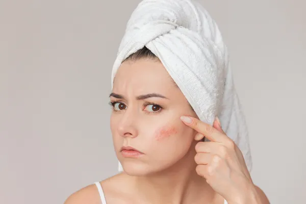 Can Facial Capillary Treatment Remove Broken Veins?