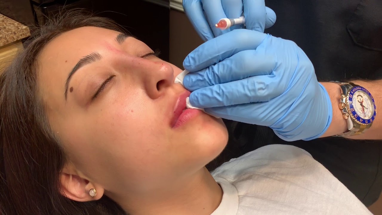 Why Do Some People Prefer Very Subtle Lip Filler Results?