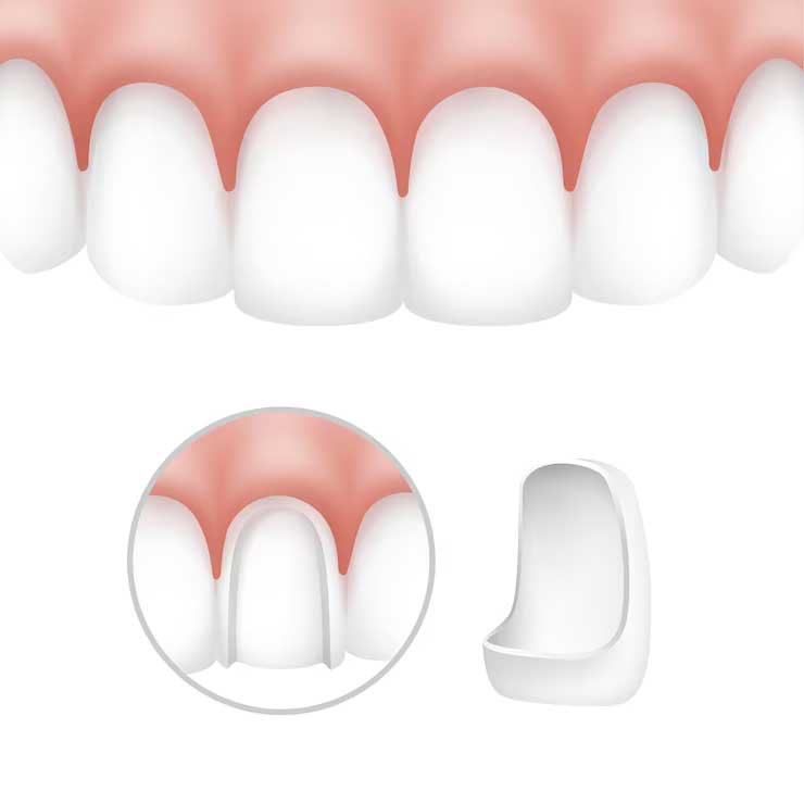 Veneers in Dubai: Procedure Details and Aftercare Tips