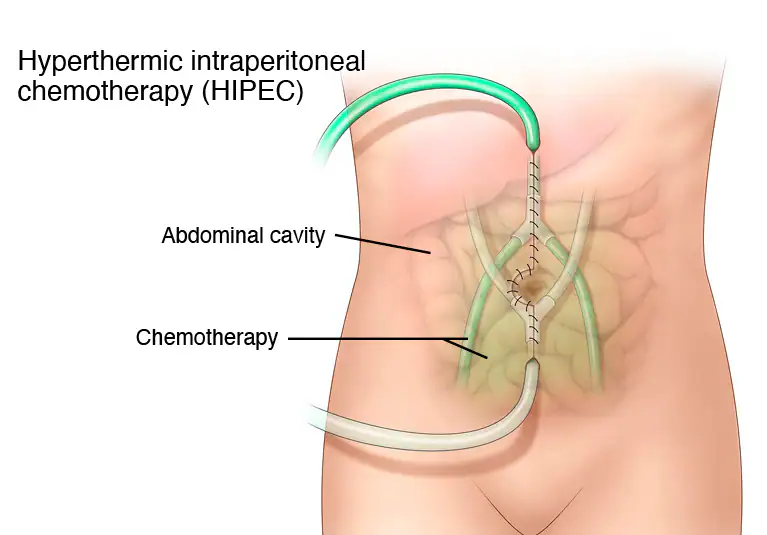 What is HIPEC Surgery? A Breakthrough in Cancer Treatment Explained