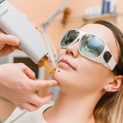 Can laser Mole Removal Improve My Appearance?