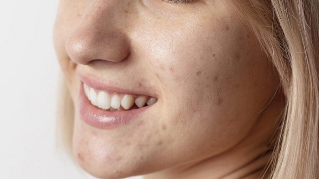 Does Subcision Treatment for Acne Scars Tighten Skin