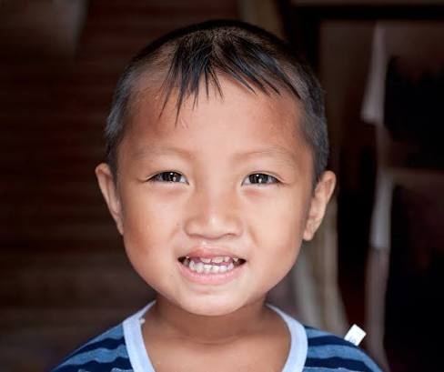 How Can Cleft Lip and Palate Surgery Change Lives?