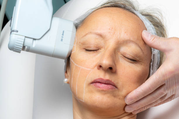 How Can Endolift Refresh Your Overall Appearance?