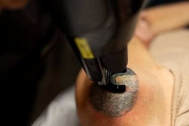 How Can Laser Tattoo Removal Restore Clearer Looking Skin?