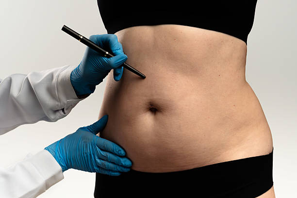 How Does Liposuction Support a Slimmer Body Profile?