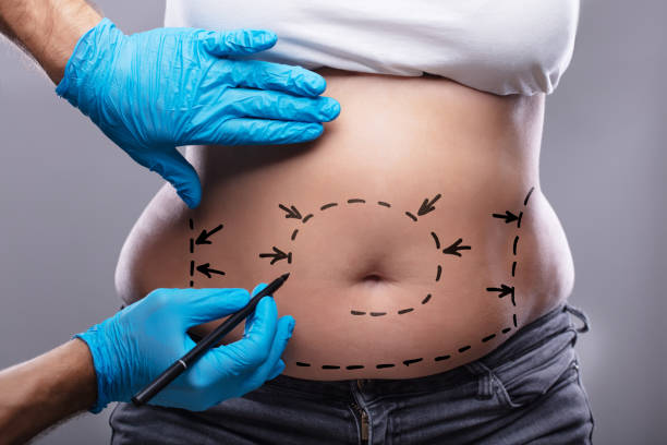 How Does Tummy Tuck Help Tighten the Abdomen?