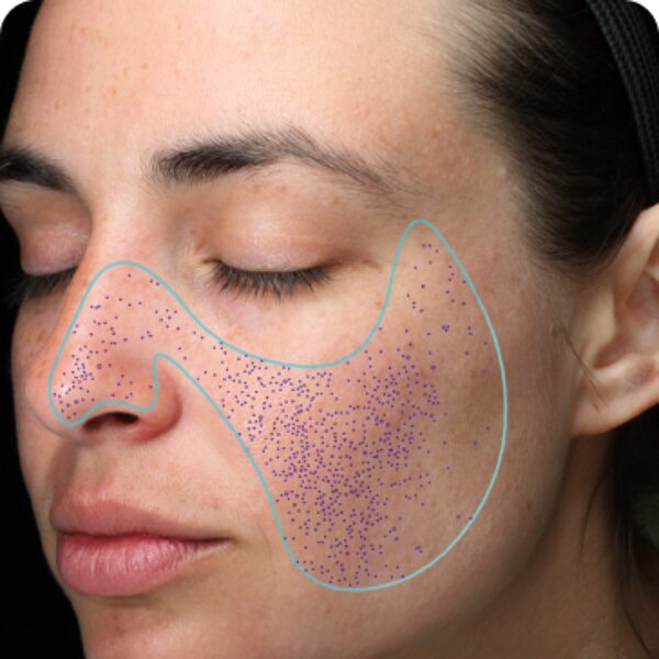 How Does Visia Skin Analysis in Abu Dhabi Help Acne?