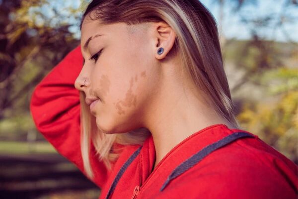 How Many Birthmarks Removal Treatment Sessions?