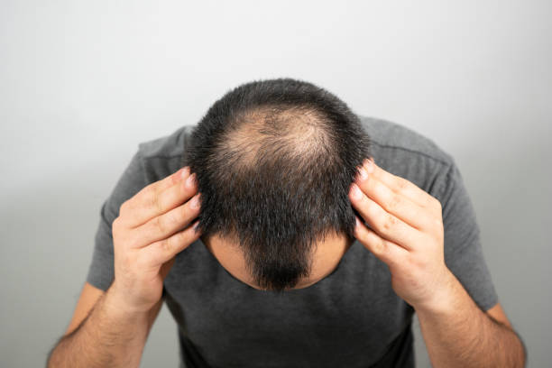 How Soon Can Hair Grow After Hair Transplant?