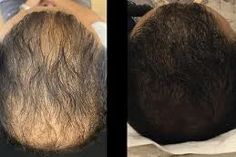 Is-PRP-Hair-Treatment-in-Abu-Dhabi-a-Permanent-Solution