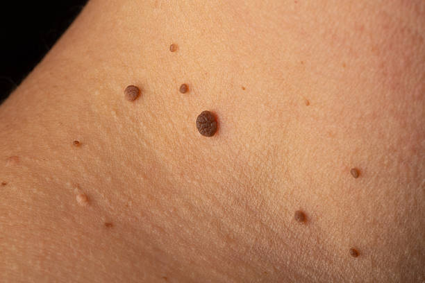 Is Skin Lesion Removal the Right Choice for You?