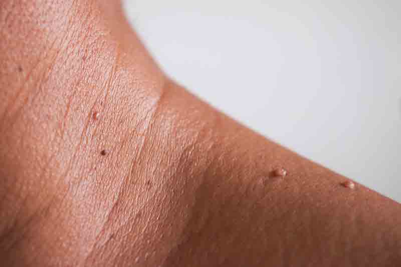 Is Skin Tag Removal in Abu Dhabi Worth the Investment