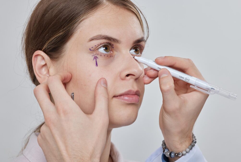 Polynucleotides Under Eyes In Manchester – Revitalise and Refresh the Delicate Eye Area