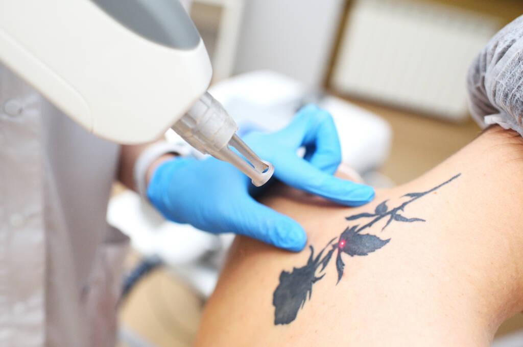Reveal Natural-Looking Skin with Laser Tattoo Removal