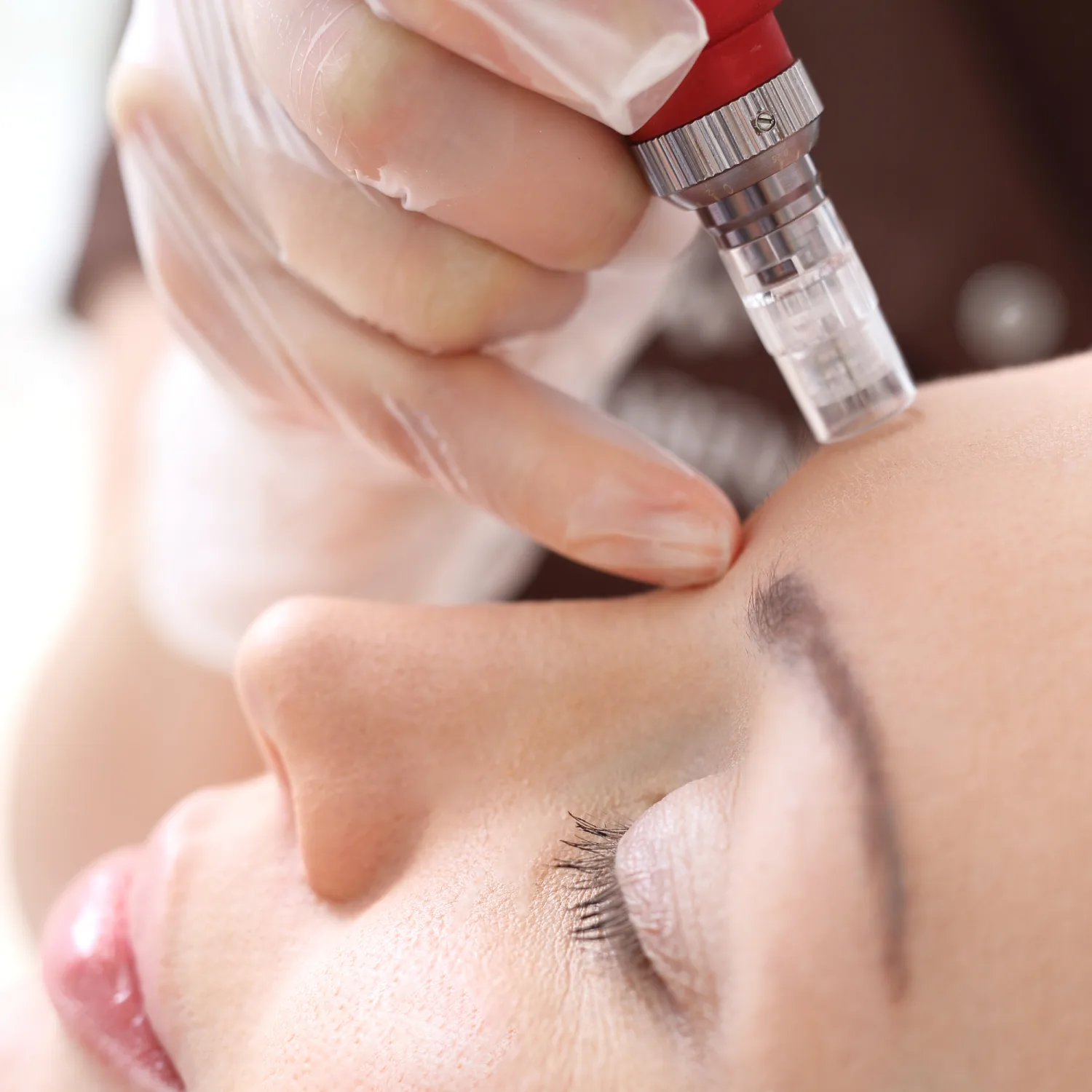 Experience the Benefits of Microneedling Treatment Today